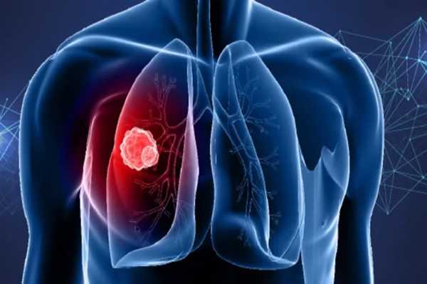 How To Recognize The Early Symptoms Of Lung Cancer