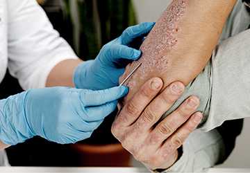 Psoriasis The Skin Condition That Could Be Killing You