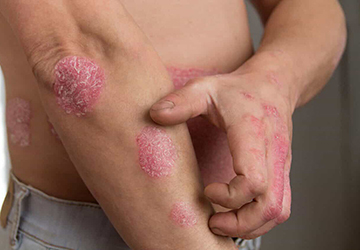 Psoriasis No More Revolutionary Treatment Eradicates Skin Condition