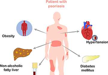 Psoriasis The Skin Condition That Could Be Killing You