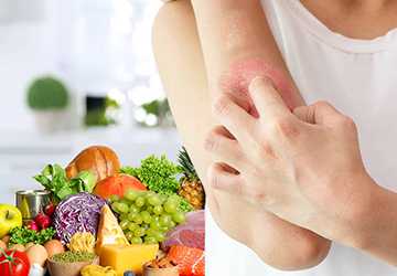 Diet and Psoriasis The Role of Nutrition in Treatment