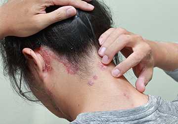 What You Didn't Know About Psoriasis