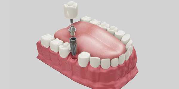 Implantes Dentários Acessíveis Perto de Você