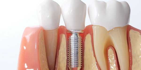 Implantes Dentários Acessíveis e Confiáveis